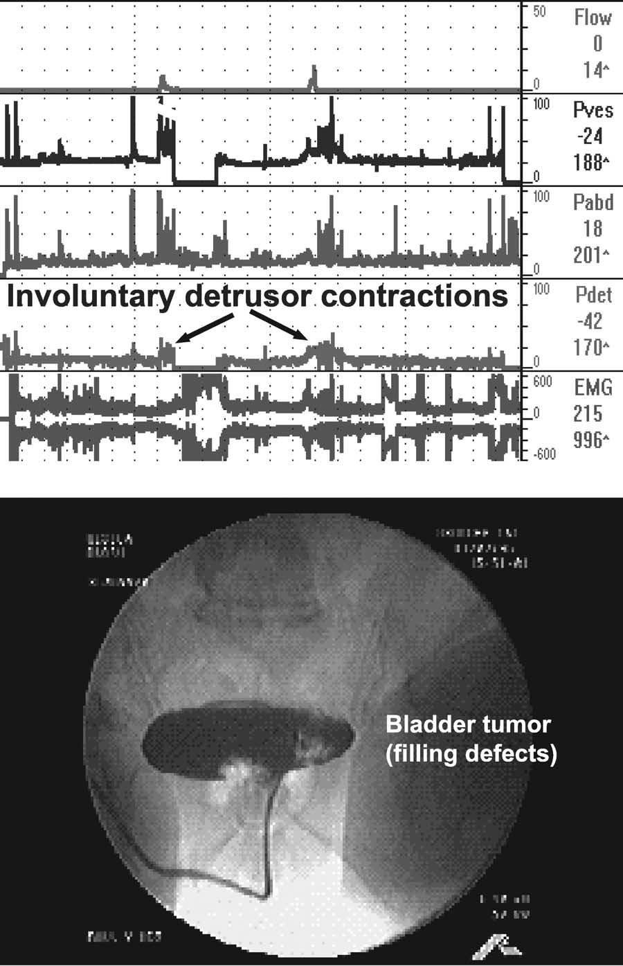 FIGURE 8. Involuntary detrusor contractions in a woman with multiple transitional cell bladder tumors. (Top) A 72-year-old woman with urgency and frequency, but no hematuria.