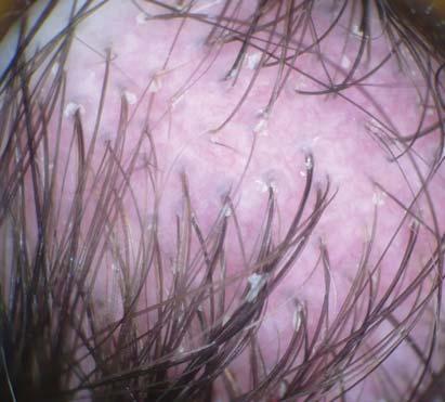 A First patient s dermoscopy of the vertex area of the scalp revealed pili