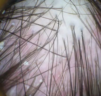B vertex area of the scalp revealed pili multigemini, perifollicular