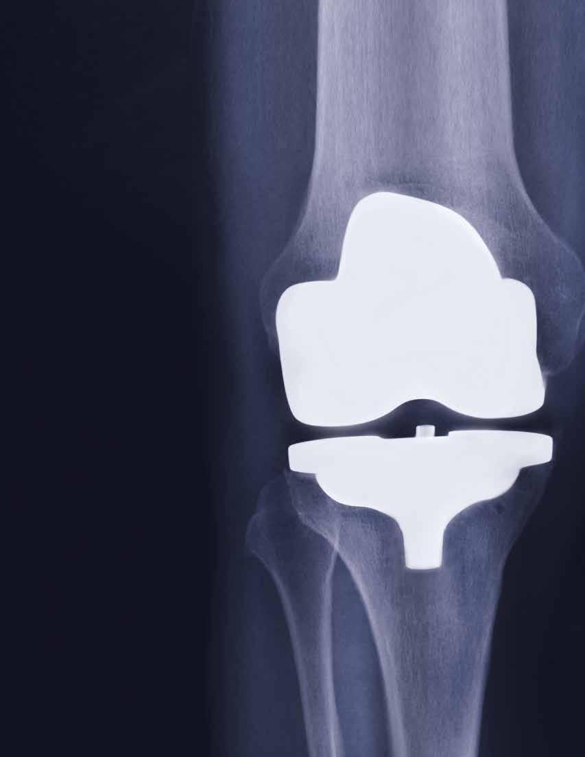 CEMENT WHY TOTAL KNEE REPLACEMENT? With almost 50 years of history, total knee replacement surgery is a very common and safe procedure for the treatment of severe arthritis.