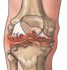 Femur Cartilage Healthy knee Patella Tibia ARTHRITIS OF THE KNEE With arthritis, the cartilage deteriorates