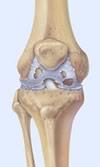 Osteoarthritis (OA) Osteoarthritis may result from wear and tear or damage to the joint