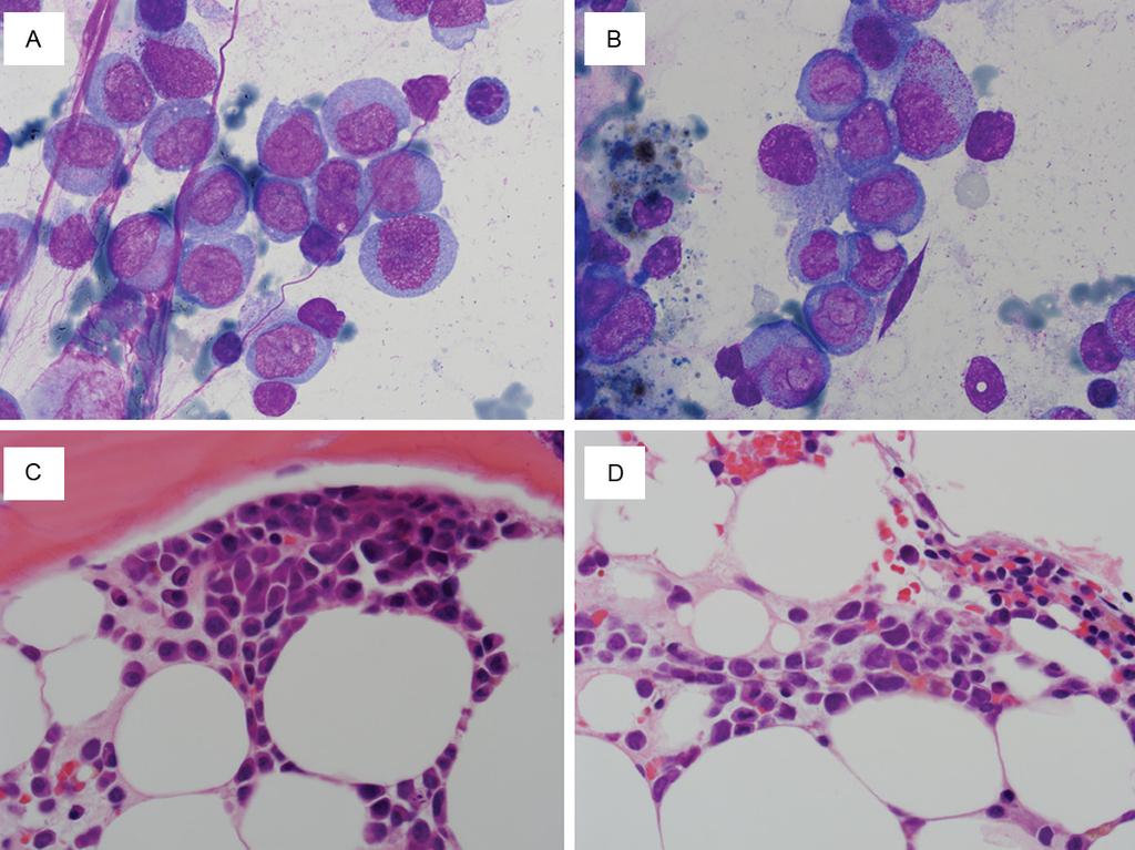 Figure 1. Increased blasts in the aspirate and core biopsy of the Day 21 bone marrow. A, B.