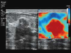 Uterine fibroadenoma Thyroid elastography Breast lesion elastogram Shear wave elastography ElastPQ uses
