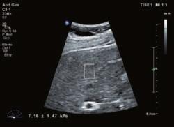 According to the latest studies, 1 using shear wave elastography may help reduce or avoid conventional
