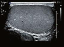 thrombosis Fetal