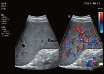 color Doppler technology that increases flow resolution, sensitivity,
