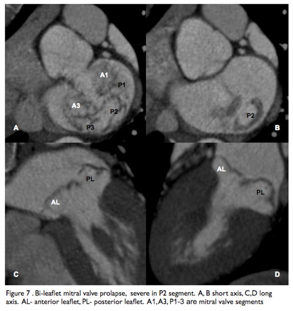 Fig. 8: Bi-leaflet mitral valve prolapse, severe in P2 segment. A, B short axis, C,D long axis.