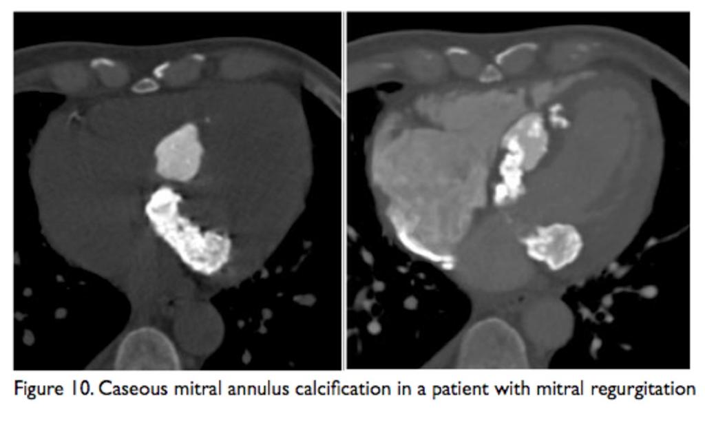 Fig. 11: Caseous mitral annulus calcification in a patient with mitral regurgitation Fig.