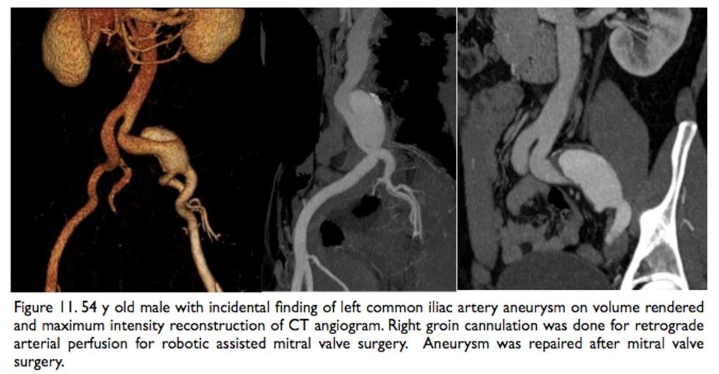 maximum intensity reconstruction of CT angiogram.