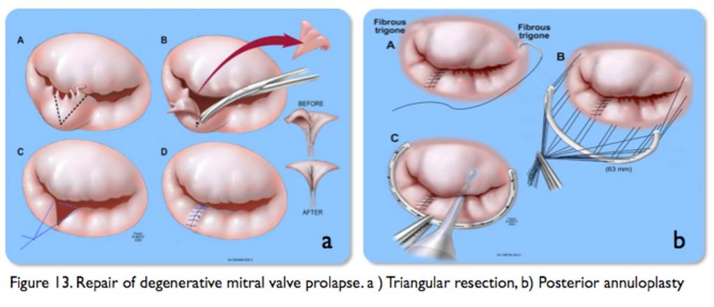 Retrograde arterial perfusion was performed through left femoral artery.