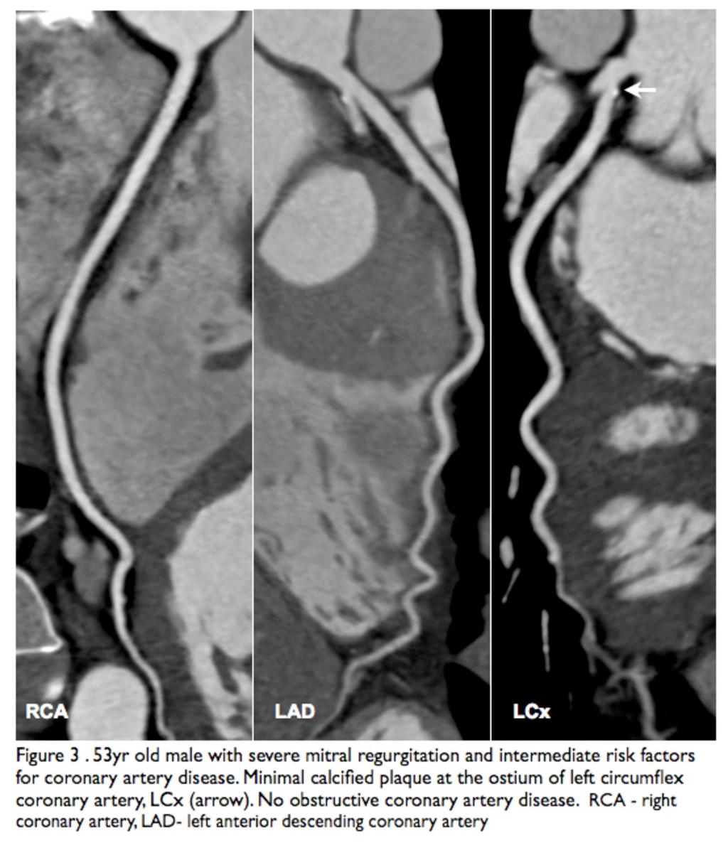 Fig. 2: Pre-operative CT technique, including retrospective ECG-gated CTA of the chest (blue horizontal lines), followed by contrast-enhanced CT of the abdomen and pelvis (yellow lines).