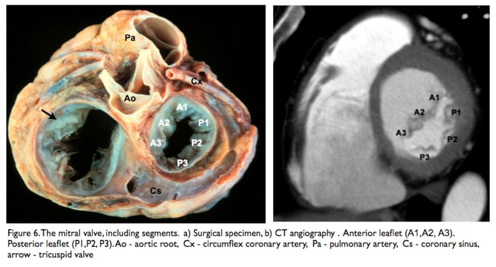 Fig. 5: 65y old male with degenerative mitral valve disease.