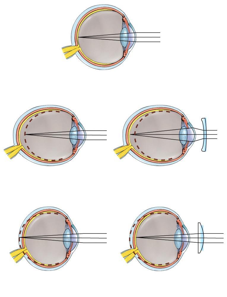 Clinical application REFRACTION ABNORMALITIES o Myopia is nearsightedness. o Hyperopia is farsightedness.