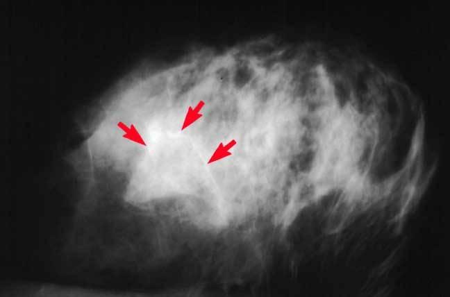 Breast Calcifications Microcalcifications shown on mammogram; calcifications are present through ductal Microcalcifications are tiny bits patterns.