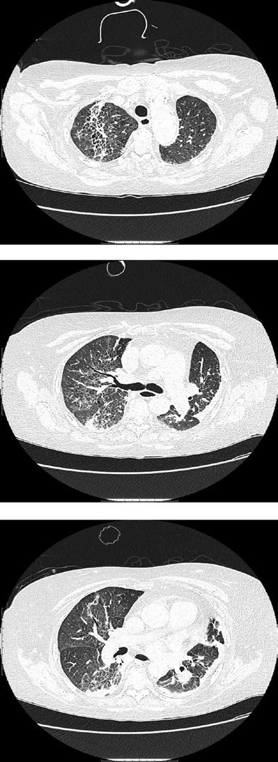 Answer 2 High-resolution computed tomography (HRCT) scan of the chest in order to investigate the new findings on the chest radiograph and shed light on the rapid deterioration of the patient.