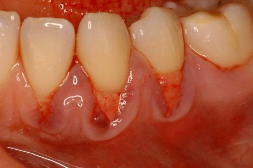 tkivni tunel ispod reţnja polu debljine a preko ogoljenih korenova zuba, i orijentiše se tako da periost naleţe na cement korena zuba te se fiksira u