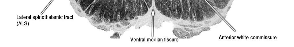 median fissure