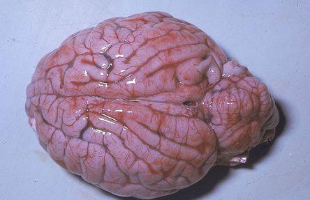 Brain edema: note that the distinction between gyri and sulci is diminished because