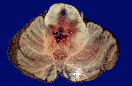 Duret hemorrhage The end result of temporal medial lobe ( transtentorial) herniation is compression of the brainstem (midbrain and pons) and stretching of small arterial branches to cause Duret