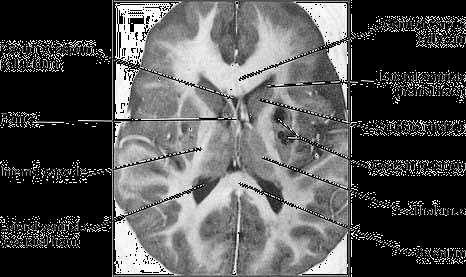 Case horizontal MRI slice at the level of the corpus striatum from a