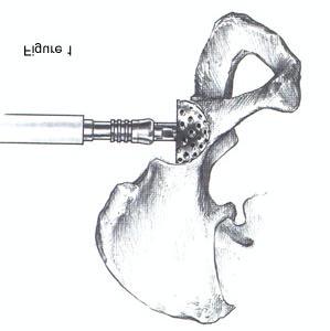 Step 1 cont. Step 2 The metal frame shell gauge that corresponds to the last reamer is placed into the acetabulum (Figure 3).