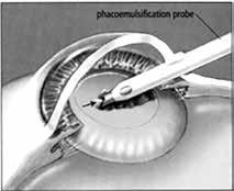DURING SURGERY You may be surprised by how little time small-incision cataract surgery takes.