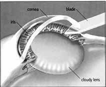 A special instrument breaks apart the old lens with sound waves (ultrasound) and then removes the pieces. This process is called phacoemulsification.