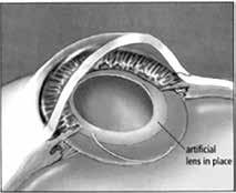 Implanting the New Lens Once your old lens has been removed, your doctor slips the new lens (IOL) in through the incision.