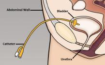 Once the bladder is filled with fluid, the clinician will then insert your suprapubic catheter through a small incision in your lower abdomen just above the pubic hairline.