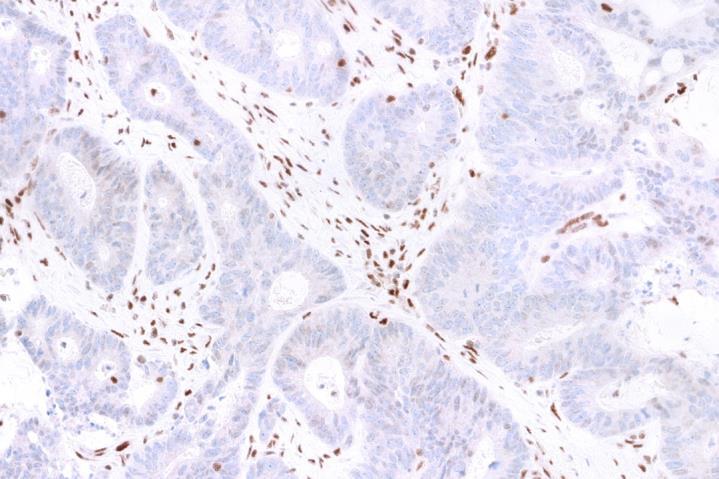Status tissue exhibits no nuclear staining in the tumor