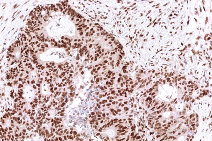 staining is seen in the tumor cells