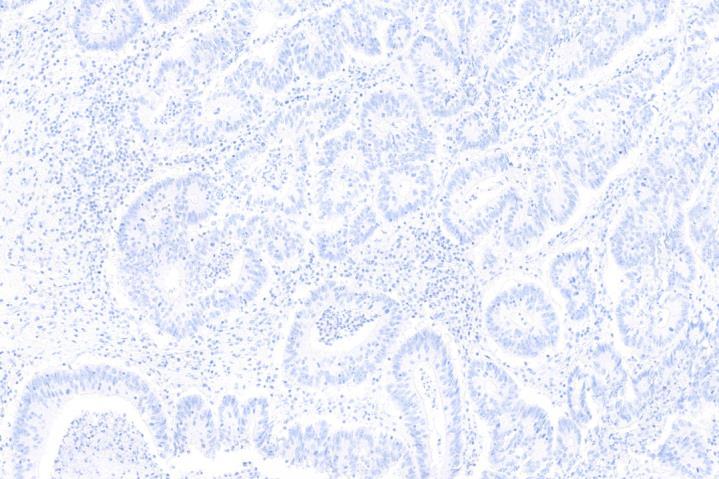 cytoplasmic background in the tumor cells;