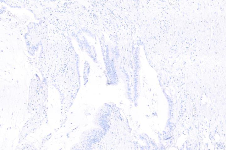 weak equivocal nuclear staining in the viable tumor