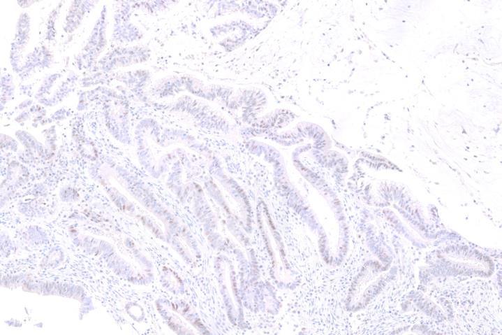 Moderate nuclear staining is present in some