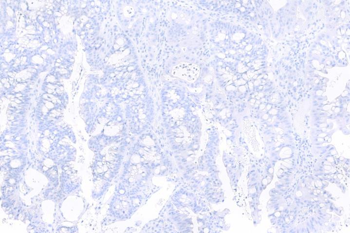 exhibits unequivocal strong cytoplasmic staining