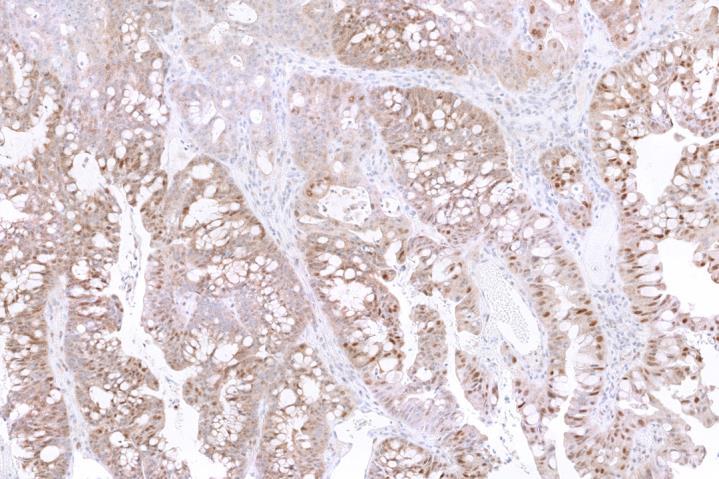 Moderate nuclear staining is present in some