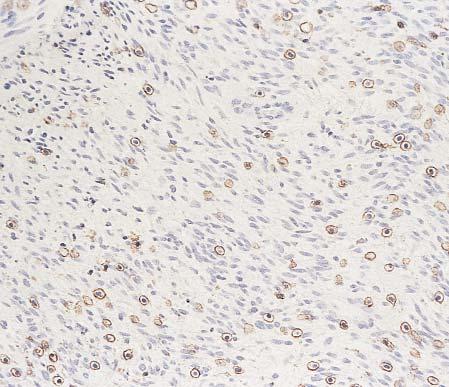 Hornick and Fletcher / KIT IN SOFT TISSUE SARCOMAS Image 1 A prominent mast cell infiltrate positive for KIT in a case of monophasic synovial sarcoma (immunohistochemical stain, 200).