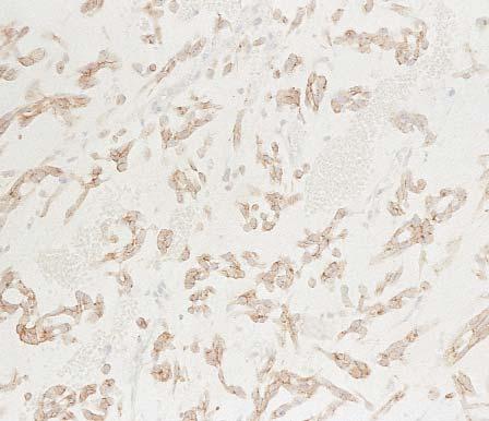 Image 3 A case of Ewing sarcoma/malignant primitive peripheral neuroectodermal tumor showing positivity for KIT (immunohistochemical stain, 200).