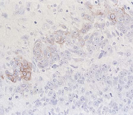 Anatomic Pathology / ORIGINAL ARTICLE Image 5 Focal membranous staining for KIT in a case of metastatic melanoma (immunohistochemical stain, 400).