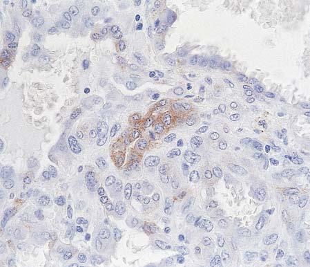 No staining for KIT was seen in either 10 low-grade endometrial stromal sarcomas or 5 follicular dendritic cell sarcomas.
