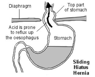 the stomach refluxing back into the oesophagus. The diaphragm is a large flat muscle that separates the lungs from the abdomen. It helps us to breathe.
