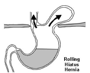 A hiatus hernia occurs when part of the stomach protrudes through the diaphragm into the chest. Types of hiatus hernia: Sliding hiatus hernia is the most common type.
