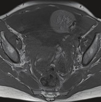 2 Case Reports in Radiology (c) (d) Figure 1: Axial T1 weighted and with fat saturation.