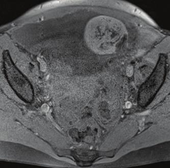 Axial T1 postcontrast image (d) demonstrates ascites with peritoneal thickening.