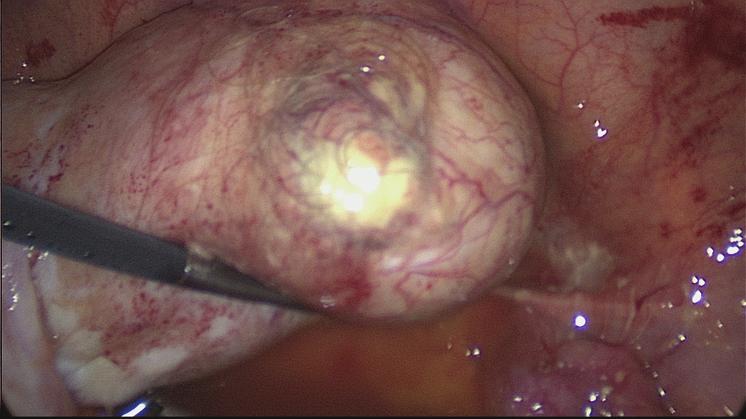 The cause of rupture may be due to torsion with infarction of the tumor, infection, malignancy and rapid growth of the cyst, direct trauma, or prolonged pressure from pregnancy or delivery as in our