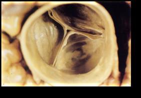 Mitral (bicuspid) valve Aortic and pulmonary semilunar