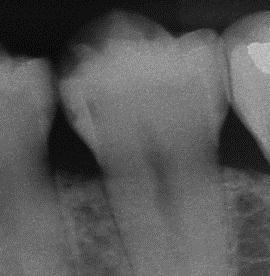 Caries past the DEJ but need to take a new BW to eliminate