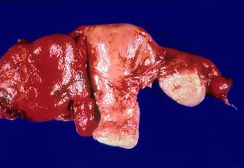 Uterus, Bilateral Fallopian Tubes, and Ovaries U: Uterus C: Cervix M U F O F: Fallopian Tube O: Normal Ovary M: Inflamed Tubo- Ovarian Mass C Note the hemorrhagic, oedematous fallopian tubes,