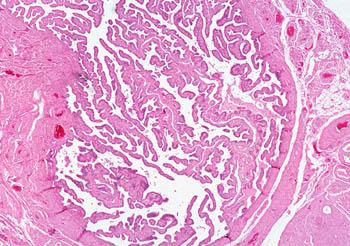 Normal Fallopian Tube - Low Power M: Mucosal Folds L: Lumen W: Wall of Tube M L W Note the delicate mucosal